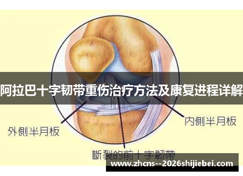 阿拉巴十字韧带重伤治疗方法及康复进程详解 阿拉巴十字韧带重伤治疗方法及康复进程详解